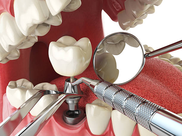 Best Emergency Dental Extractions in Okemos, MI